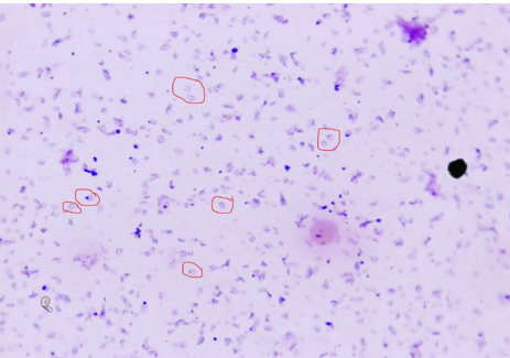 Giemsa-Stained Thick Film, Showing Plasmodium falciparum